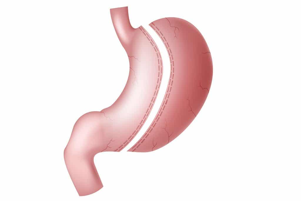 Wie eine Magenverkleinerung Türkei Ihre Gesundheit verbessern kann