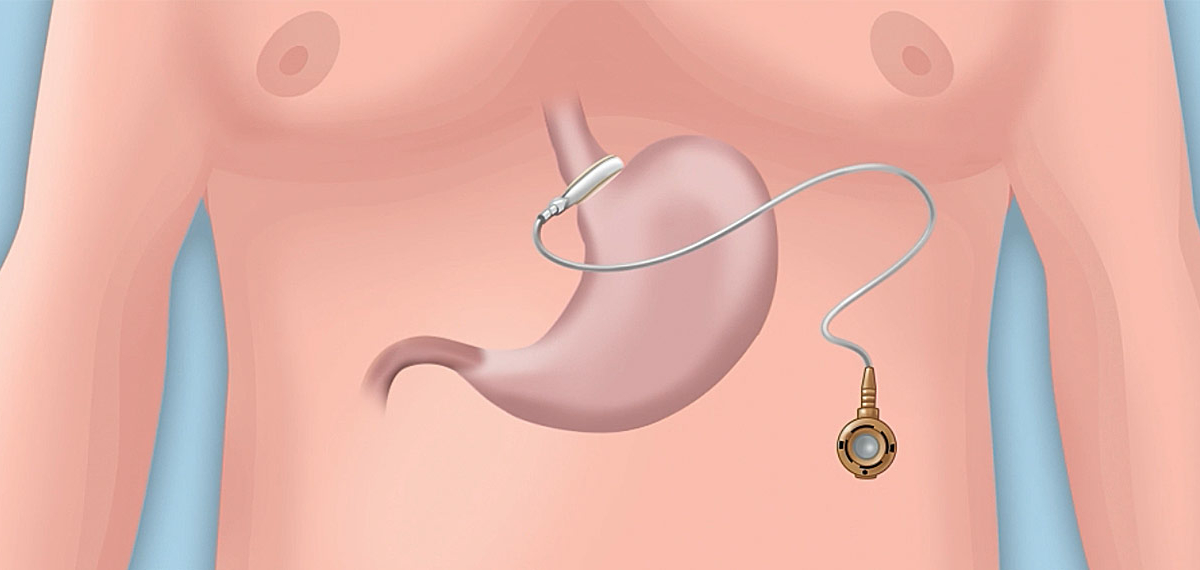 Wie eine Magenverkleinerung Türkei Ihre Gesundheit verbessern kann